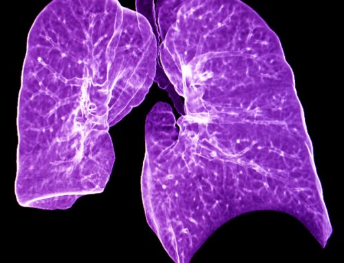 Autoimmune lung disease: Early recognition and treatment helps