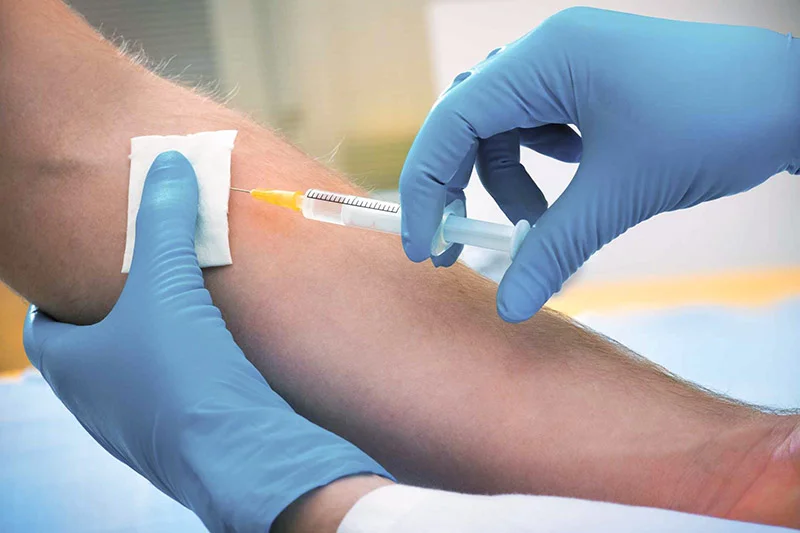 TB Tuberculosis Test Purpose Procedure Results 49 OFF