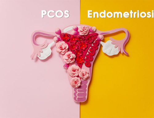 PCOS vs. Endometriosis – What’s the difference?