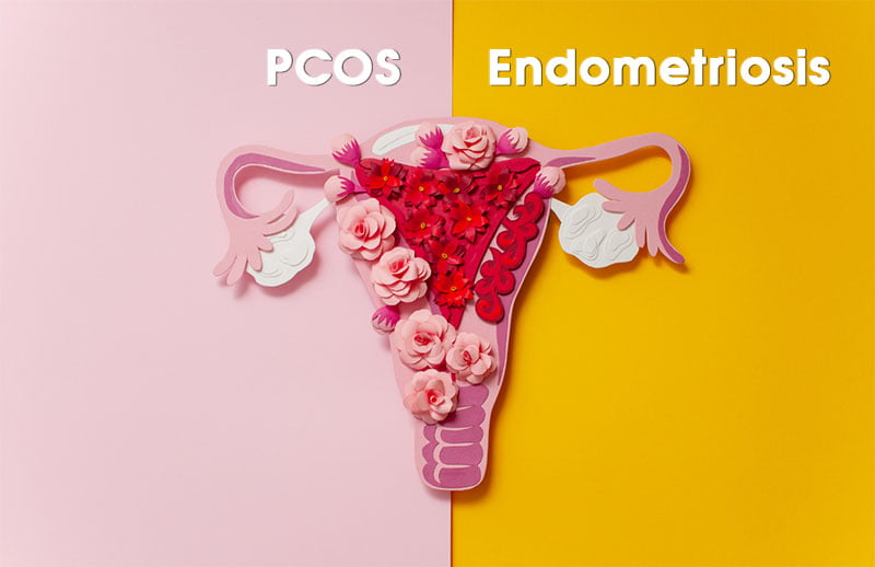 PCOS Vs Endometriosis What s The Difference SanoMed Medical Clinic